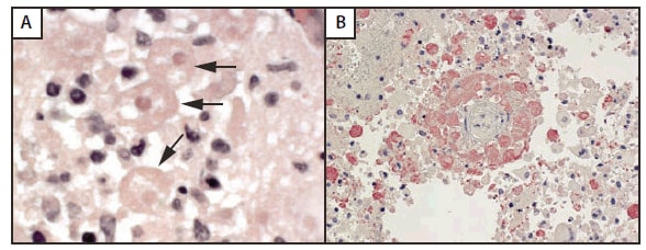 The figure shows organ donor brain tissue revealing amebae suggestive of Balamuthia (indicated by arrows) (A), and immunohistochemical staining showing antigens (red) of free-living amebae (B). On Dec. 17, 2009, immunohistochemical and indirect immunofluorescent stains revealed antigens of free-living amebae in the brain tissue; polymerase chain reaction results confirmed Balamuthia infection.