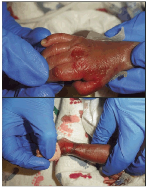 The figure shows zinc deficiency dermatitis manifesting as bullous and erosive lesions on the hands and feet in a newborn infant in Washington, DC during December 2012. In mid-December 2012, three extremely premature infants with cholestasis in a neonatal intensive care unit developed dermatitis in the diaper region, perioral erosions, and bullae on the dorsal surfaces of their hands and feet.