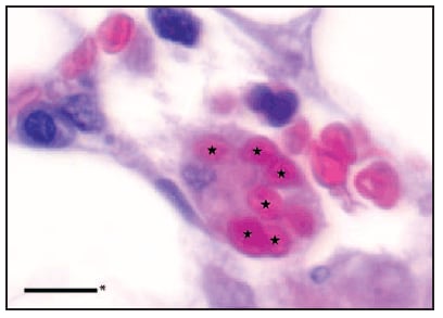 The figure shows stars indicating erythrocytes phagocytized by a macrophage in a hematoxylin and eosin-stained section of bone marrow biopsy from a patient with fatal dengue-associated hemophagocytic lymphohistiocytosis in 2012. The liver biopsy showed extensive liver damage, including marked steatosis and ballooning degeneration with neutro¬philic and histiocytic aggregates and portal lymphocytic infiltrates. Macrophages with intracellular erythrocytes were noted in the bone marrow biopsy.