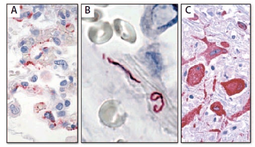 The figure above shows immunohistochemistry for detecting pathogens in tissue. Red color indicates site of the pathogens: A) Hantavirus proteins can be seen in endothelial cells in the lung of a patient; B) Leptospira organisms are present in large blood vessels in the lung; C) West Nile virus antigens can be seen in neurons in a patient with encephalitis.