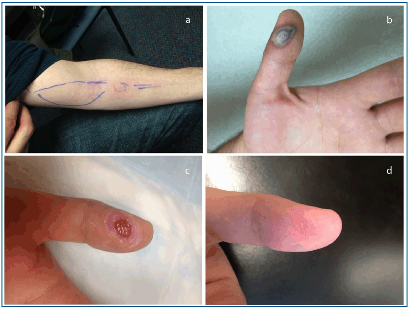 The figure displays four photographs showing the progression of vaccinia virus (VACV) infection in a VACV-immunized laboratory worker inadvertently inoculated with VACV in Massachusetts during 2013.
