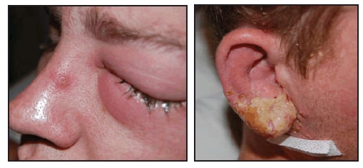 The figure shows the left eye and right ear of a man with laboratory acquired vaccinia virus infection from Virginia in 2008. The man worked for a laboratory at an academic institution in Virginia. He went to a local urgent care clinic reporting swelling of cervical lymph nodes and pain and inflammation of his right earlobe associated with purulent discharge beginning July 2, followed on July 3 by a feverish feeling and swelling of his left eye with no change in his vision. The patient was prescribed cephalexin for presumed bacterial infection and prednisone for swelling However, on July 6, his symptoms worsened, and he went to a hospital emergency department. The patient was given bacitracin for his eye and discharged. That night, he noted pustular lesions at similar stages of development on his right ear and left eye.