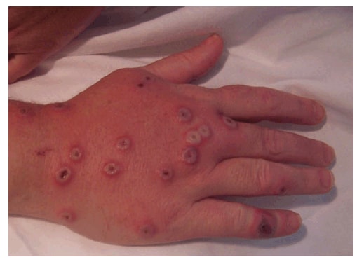 The figure is a photograph showing the right hand of a woman aged 35 years with vaccinia virus lesions and pronounced redness and edema on day 11 after contact with a raccoon rabies vaccine bait in Pennsylvania in 2009.