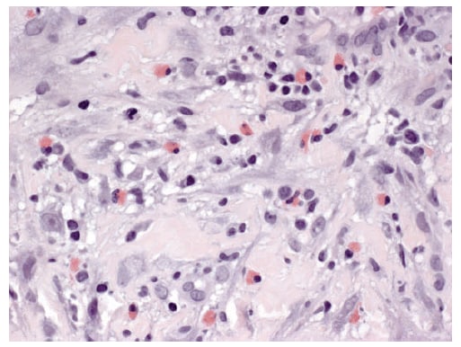 The figure above shows eosinophils observed in breast biopsy tissue from a patient with idiopathic granulomatous mastitis in Indianapolis, Indiana, in 2009.