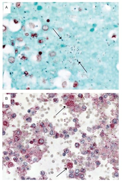 The Figure consists of two slides showing Streptococcus pneumoniae infection in a patient with confirmed pandemic H1N1 virus infection.