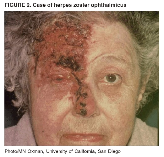 FIGURE 2. Case of herpes zoster ophthalmicus