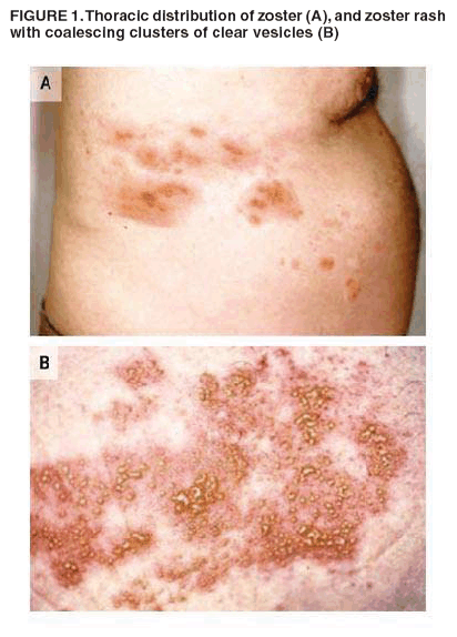 FIGURE 1. Thoracic distribution of zoster (A), and zoster rash
with coalescing clusters of clear vesicles (B)