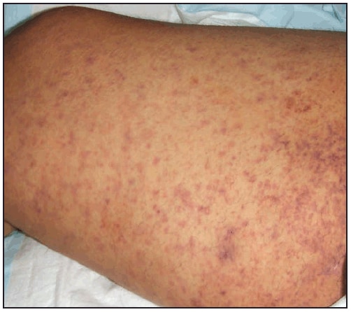This figure is a photograph showing a maculopapular rash with central petechiae associated with Rocky Mountain spotted fever.