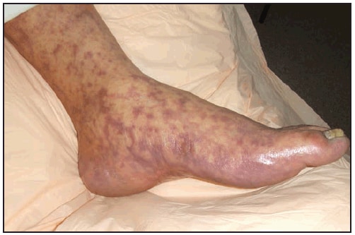 This figure is a photograph showing a late-stage petechial purpuric rash involving the sole of the foot in a patient with Rocky Mountain spotted fever.