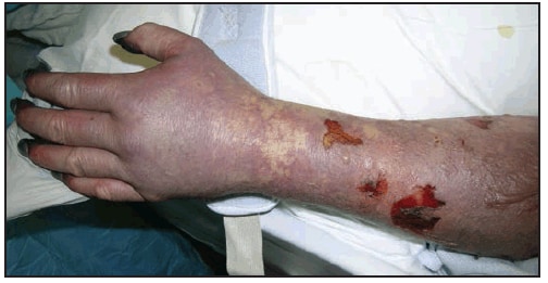 This figure is a photograph showing gangrene of the digits in a patient with late-stage Rocky Mountain spotted fever.