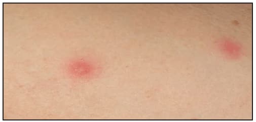 This figure is a photograph showing a vesiculopapular rash associated with Rickettsia parkeri rickettsiosis.