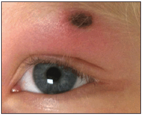 rr6502a1f26.gif This figure is a photograph showing an eschar on a patient with Rickettsia species 364D rickettsiosis.