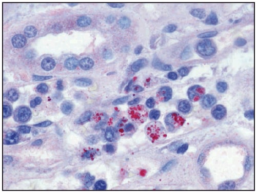 This figure is a photograph showing an immunohistochemical stain demonstrating Ehrlichia chaffeensis morulae (red) within monocytes in the kidney of a patient with ehrlichiosis.