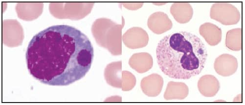 This figure is a photograph showing a Wright stain of peripheral blood smears showing an intramonocytic morula associated with Ehrlichia chaffeensis infection (left) and an intragranulocytic morula (right), such as associated with Ehrlichia ewingii or Anaplasma phagocytophilum infection.