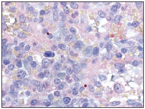This figure is a photograph showing an immunohistochemical detection of Anaplasma phagocytophilum morulae (red) in the spleen of a patient with splenic rupture associated with anaplasmosis.