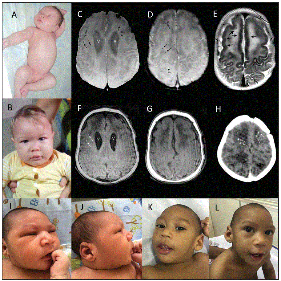 The figure above is a composite of clinical photographs, magnetic resonance, and computed tomography images of two infants with congenital Zika syndrome in Brazil during October 2015–Octoboer 2016.