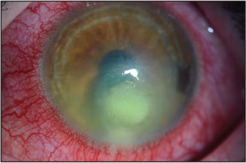 The figure above is a photo that shows findings characteristic of a contact lens–related corneal infection.