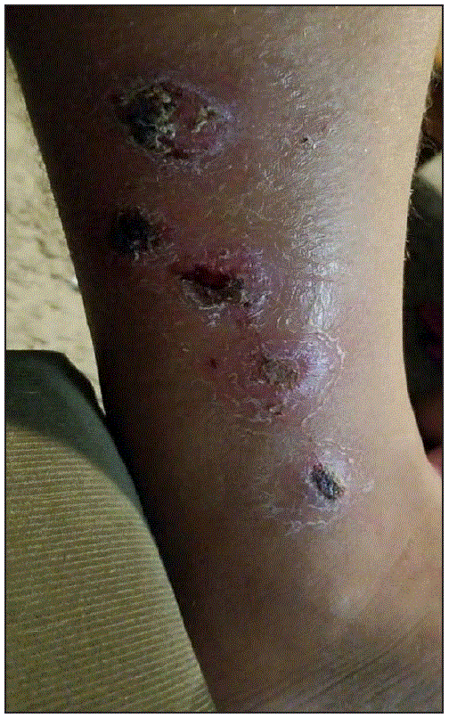 The figure is a photograph showing a Corynebacterium diphtheriae–infected lower leg wound in a patient from New Mexico in 2018.