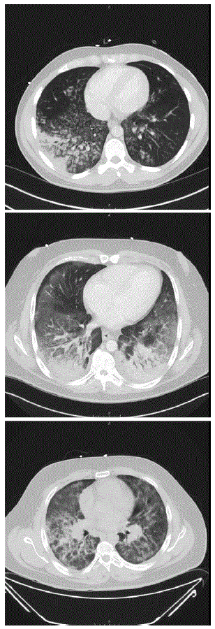 The figure consists of three computerized tomography images showing diffuse lung infiltrates in three patients with e-cigarette–associated severe lung disease in North Carolina, during July–August 2019.