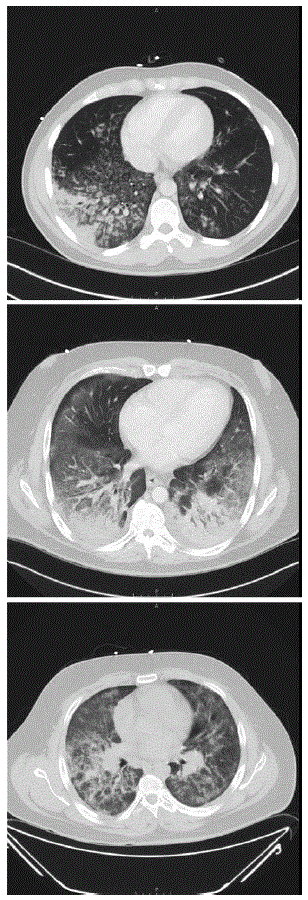 Outbreak of Electronic-CigaretteAssociated Acute Lipoid Pneumonia North Carolina, JulyAugust 2019 | MMWR Outbreak of Electronic-CigaretteAssociated Acute Lipoid Pneumonia North Carolina, JulyAugust 2019 | MMWR