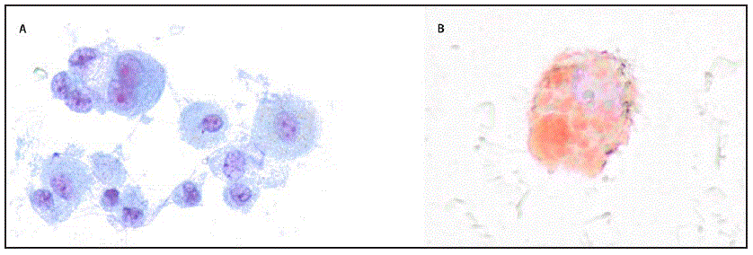 The figure shows microscopy of a bronchoalveolar lavage sample (Papanicolaou stain and oil red O stain) from a patient with acute lung injury associated with vaping in North Carolina, during July–August 2019.