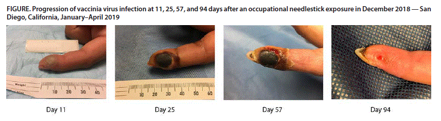 The figure consists of a panel of photos showing the progression of vaccinia virus infection in a finger at 11, 25, 57, and 94 days after an occupational needlestick exposure in December 2018, in San Diego, California, during January–April 2019.