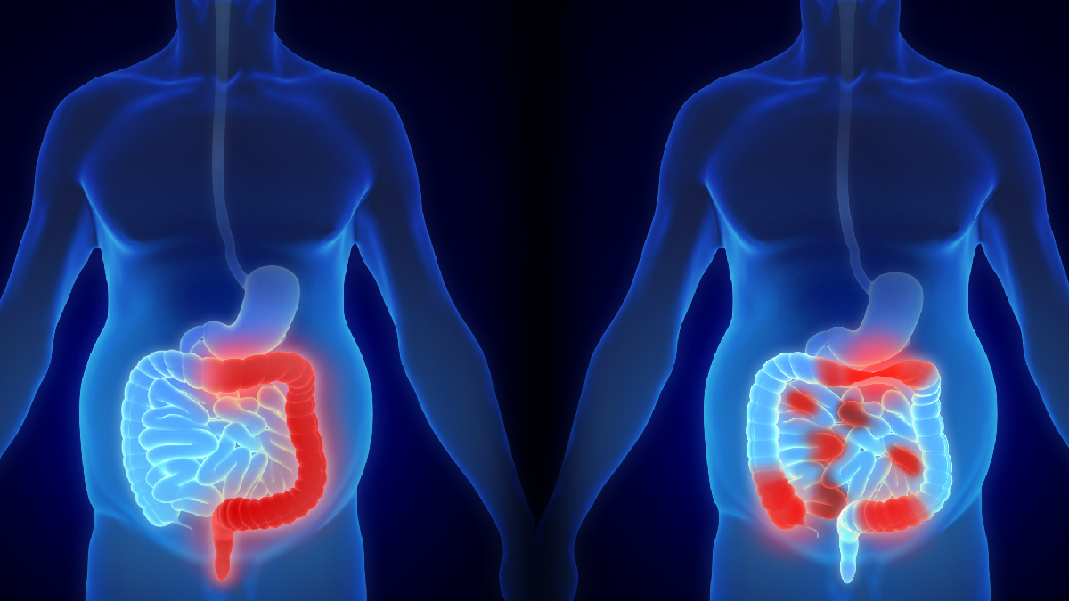 Traitement de la maladie inflammatoire de l'intestin