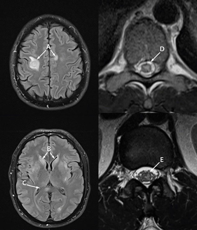 The figure is a magnetic resonance imaging (MRI) of the brain, thoracic spine, and conus medullaris of a with monkeypox-associated encephalomyelitis.