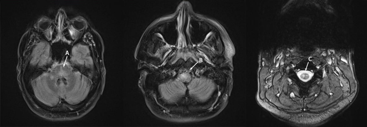 Magnetic resonance imaging (MRI) of the brain and cervical spine of a patient with monkeypox-associated encephalomyelitis.