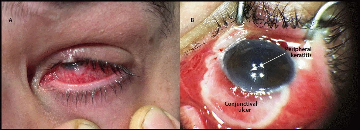 The figure is a pair of images illustrating the left eye in a patient in the United States with HIV-associated immunocompromise and ocular monkeypox, with conjunctivitis and conjunctival lesion earlier in the course of monkeypox illness, and with conjunctival ulcer and peripheral keratitis later in the course of monkeypox illness during August–September 2022.