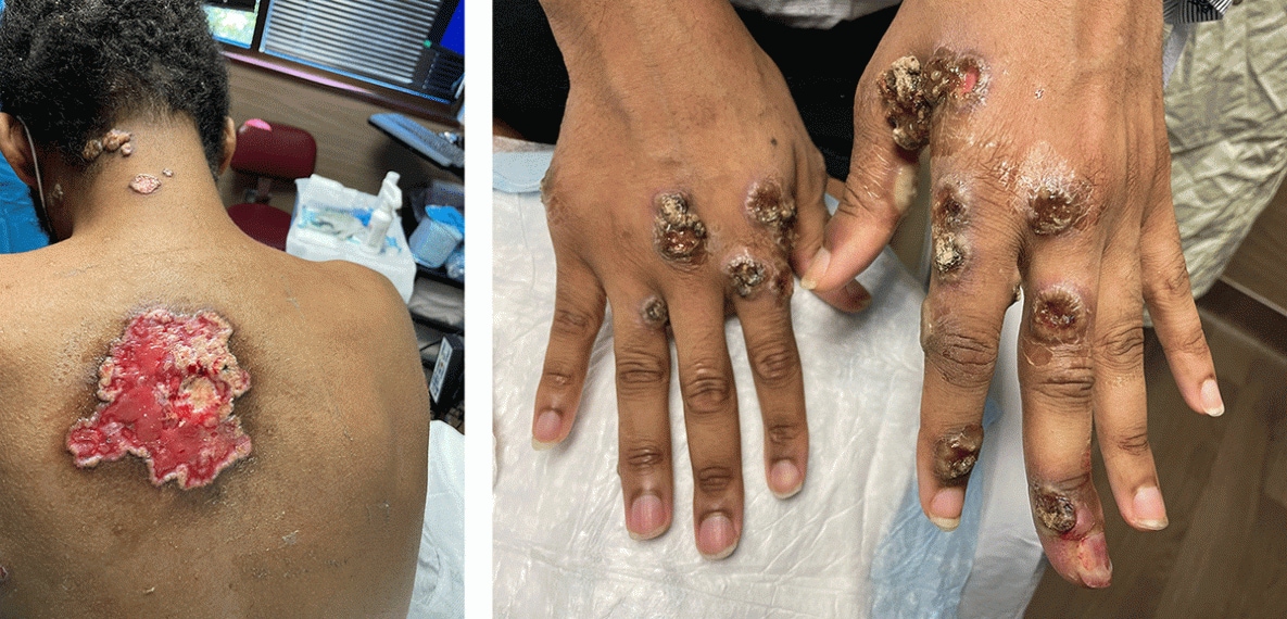 This figure is an image of patients with severe monkeypox infection. One patient has a large monkeypox lesion on their back and the other patient has several monkeypox lesions on their hands.