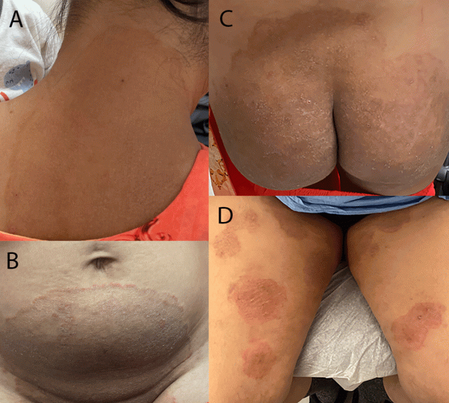 The figure includes four photographs of lesions occurring on the neck, abdomen, and thigh areas of two patients in New York City, caused by the first reported U.S. cases of tinea due to Trichophyton indotineae infection during December 2021–March 2023.
