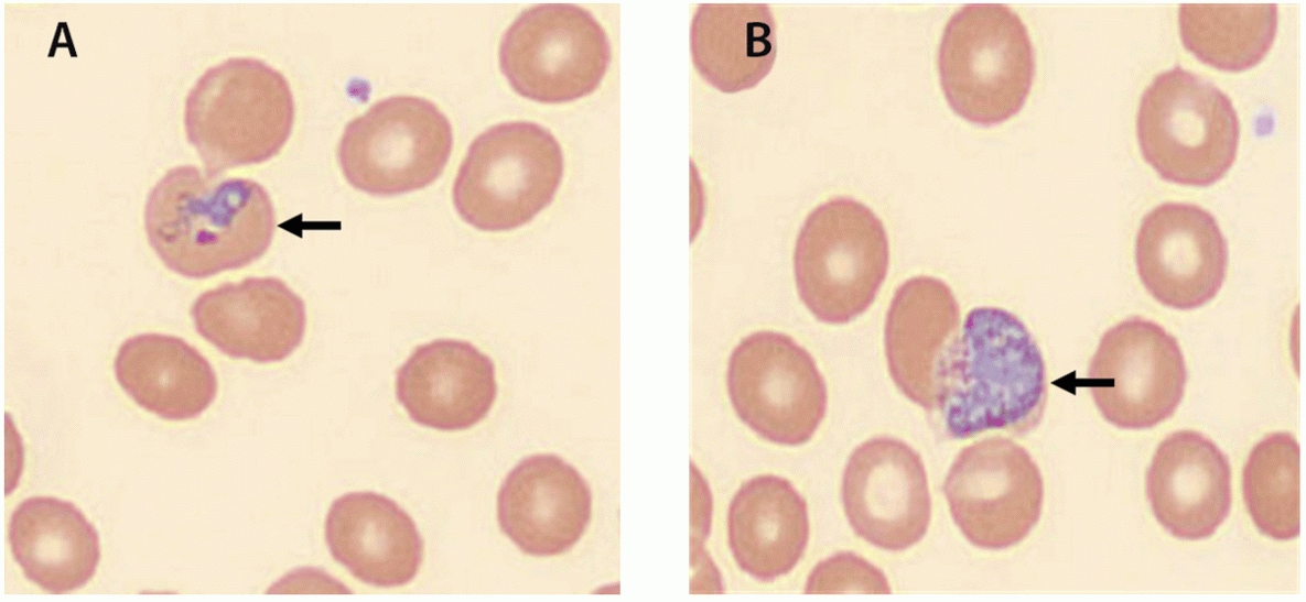 The figure is an image of a thin blood smear illustrating Plasmodium vivax ring-form trophozoite and gametocyte in Florida and Texas during May 2023.