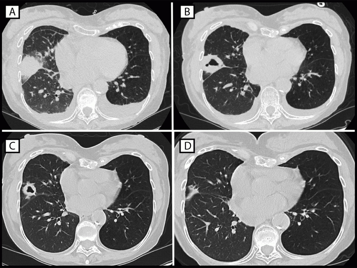 The figure consists of computed tomography images of the chest of patient A, who experienced infection with Legionella species (other than Legionella pneumophila) after receipt of a transplanted right lung from a donor who had drowned in fresh water. Features of the images include dense consolidative opacity with surrounding ground glass opacification on postoperative day 9, thick-walled cavitation on postoperative day 16, resolving lesion with thinning of cavity walls on postoperative day 29, and continuing improvement on postoperative day 119.
