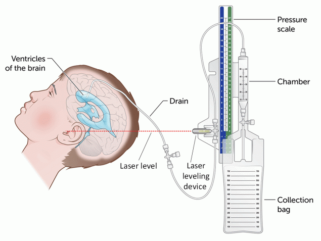 Infections Associated with Medtronic Duet External Ventricular Drains — Rhode Island Hospital, Providence, Rhode Island, January 2023–January 2024 The figure is an illustration of the components of an external ventricular drain system.