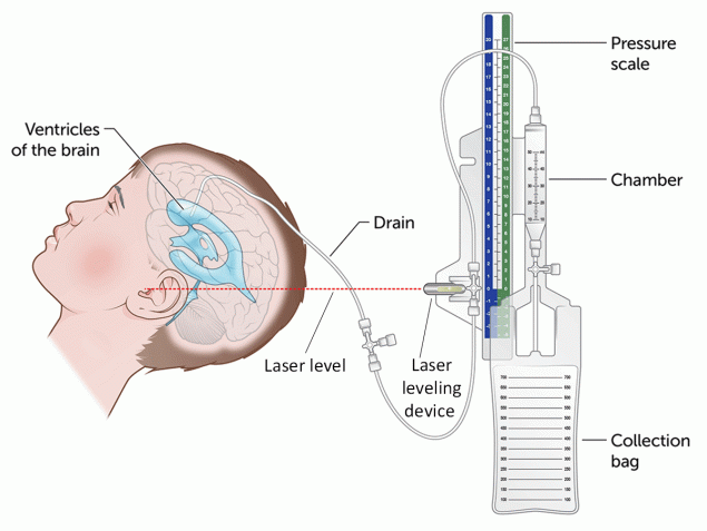 The figure is an illustration of the components of an external ventricular drain system.