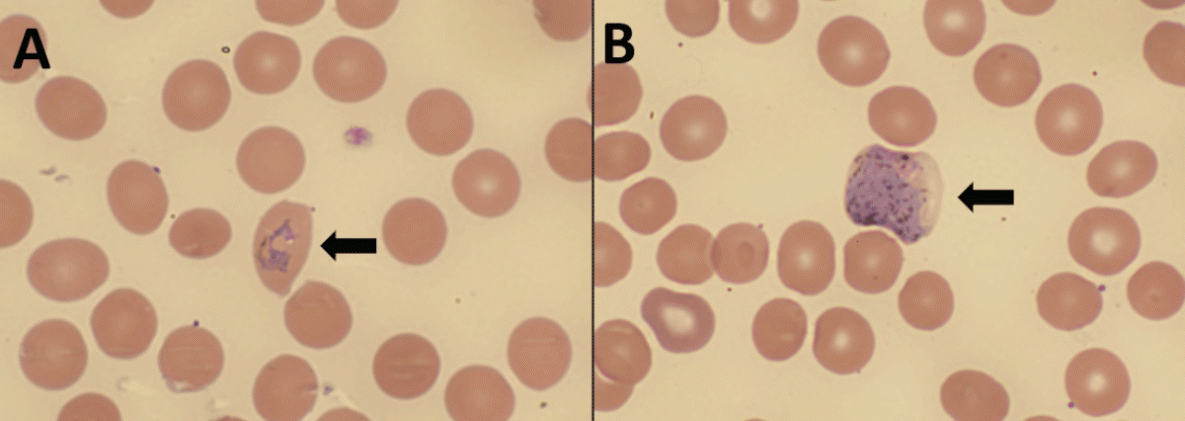 Locally Acquired (Autochthonous) Mosquito-Transmitted Plasmodium vivax Malaria — Saline County, Arkansas, September 2023 The figure comprises two photographs of a thin blood smear from the patient in Arkansas in September 2023, demonstrating Plasmodium vivax/ovale ring-form trophozoite and gametocyte.