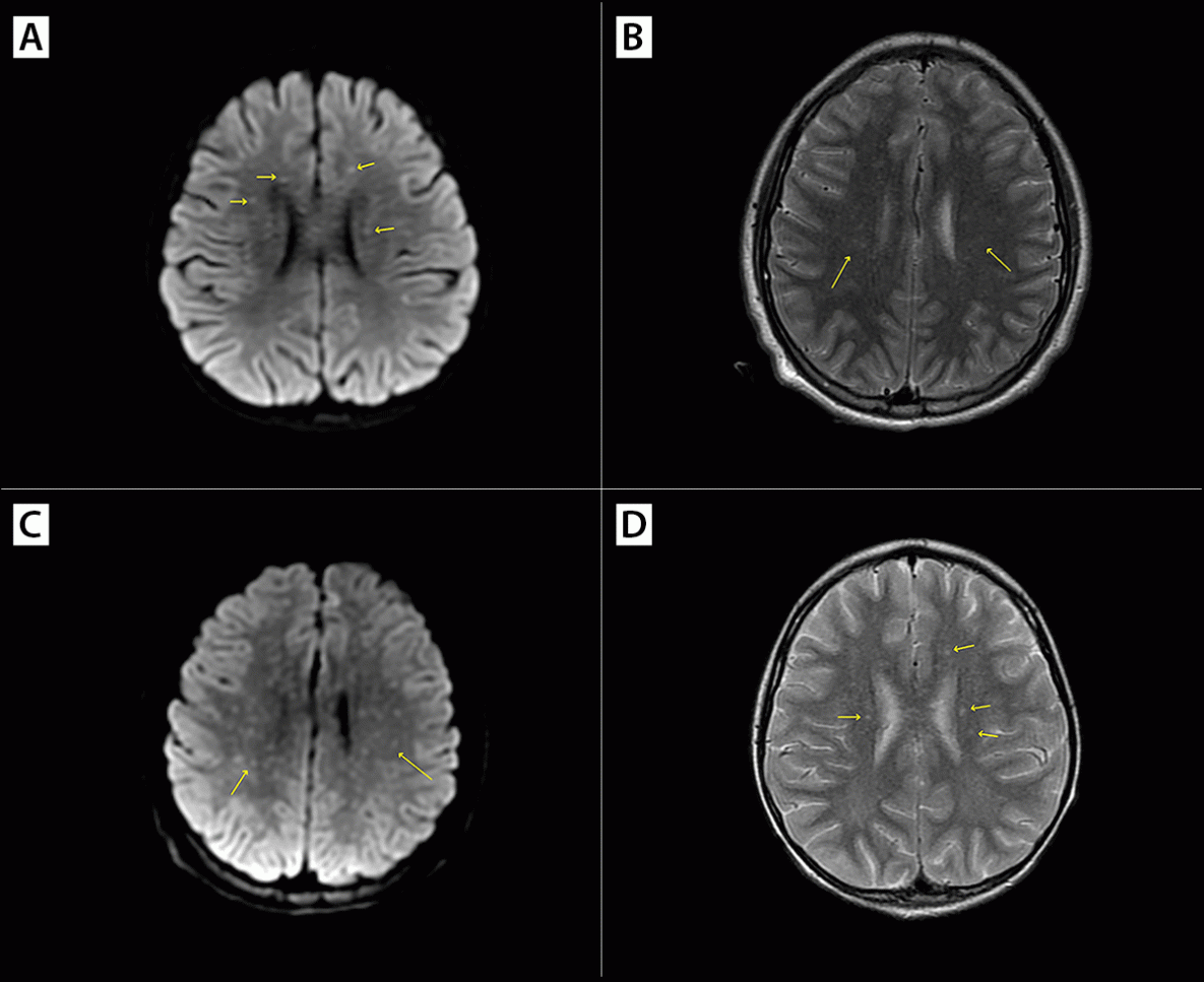 Severe and Fatal Rocky Mountain Spotted Fever After Exposure in Tecate, Mexico — California, July 2023–January 2024