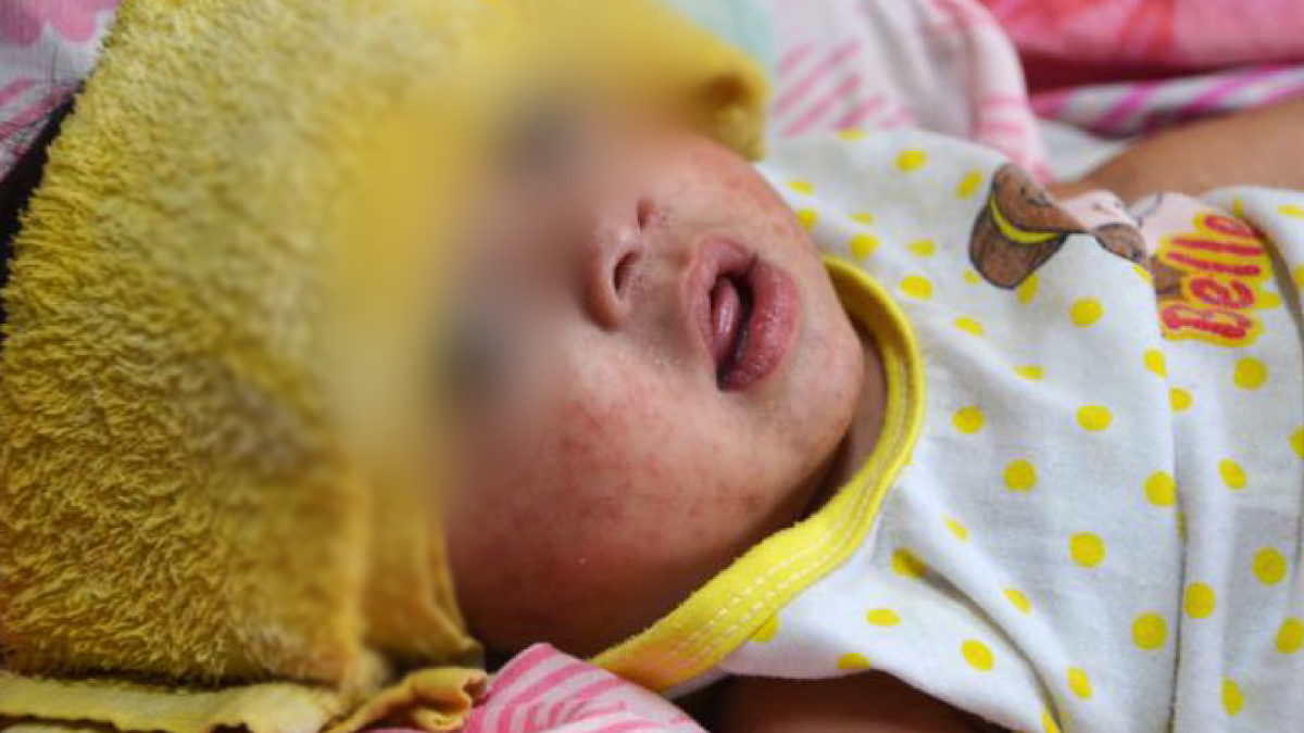 Measles Update — United States, January 1–April 17, 2025 - Centers for Disease Control and Prevention | CDC (.gov)