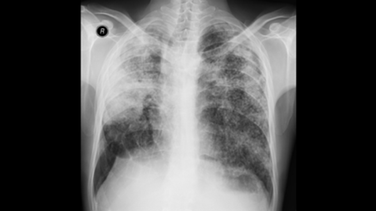 The image shows the chest X-ray from a coal worker with pneumoconiosis.