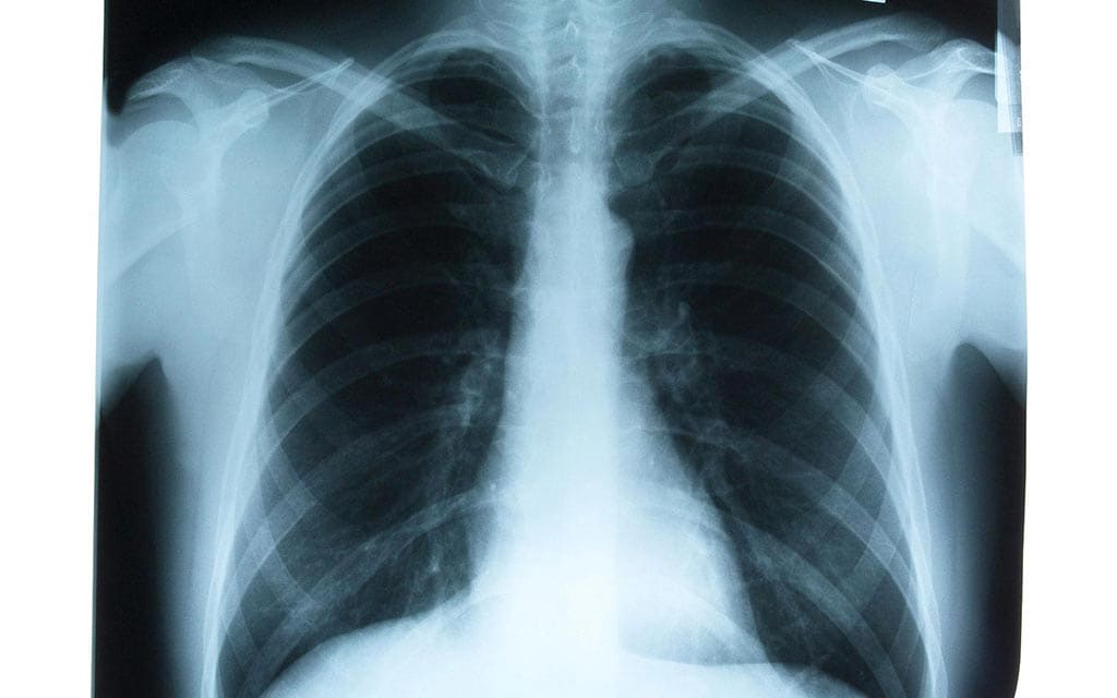 Lung xray.