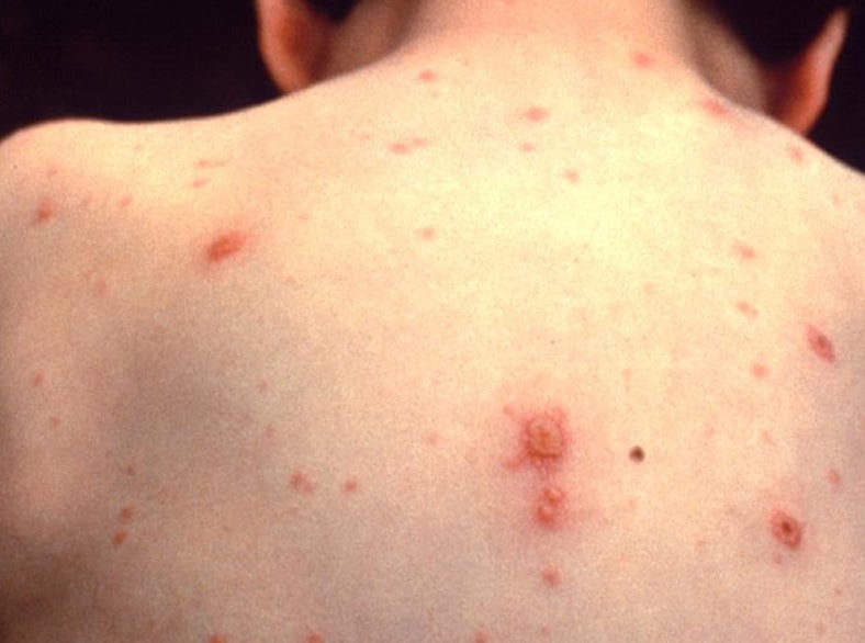 This person's back shows what a chickenpox rash looks like.