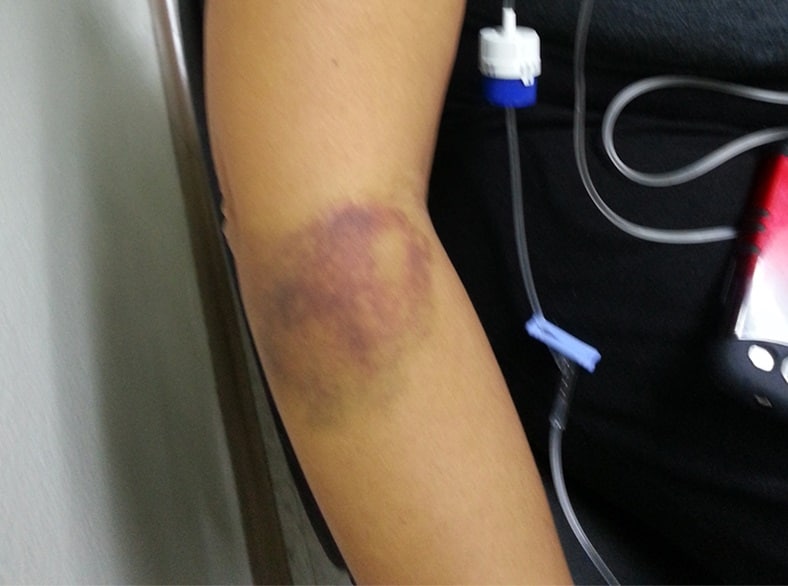 An arm with severe bruising.