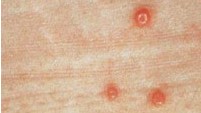 Close-up of three molluscum sores on a person's skin.