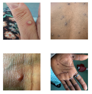 Four photos of monkeypox rashes on different parts of the body.