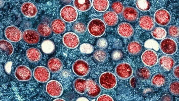 Monkeypox in the United States and Around the World: Current Situation | Monkeypox Monkeypox in the United States and Around the World: Current Situation | Monkeypox