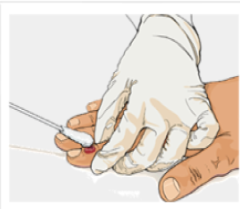 Monkeypox Collection Getting Tested for Monkeypox | Monkeypox | CDC