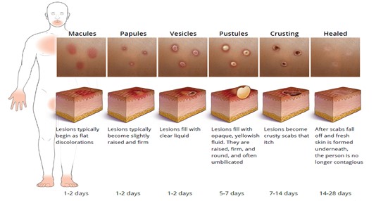Shows the stages of monkeypox lesions from macules to scabs