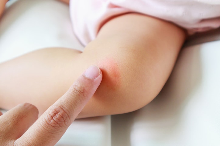mother apply antiallergic cream at baby knee with skin rash and allergy with red spot cause by mosquito bite