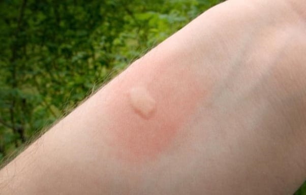 Picadura de mosquito en la parte interna del antebrazo de una persona.